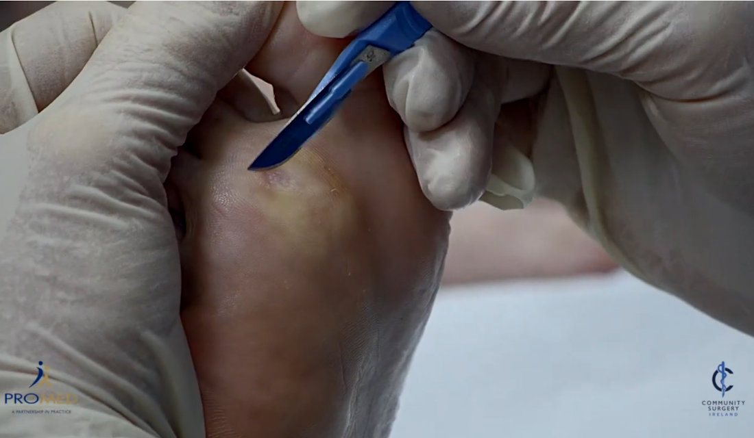 Cryosurgery for plantar warts