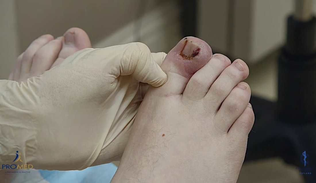 Wedge resection and nail bed ablation for ingrown toenails