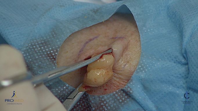 Removal of a lipoma
