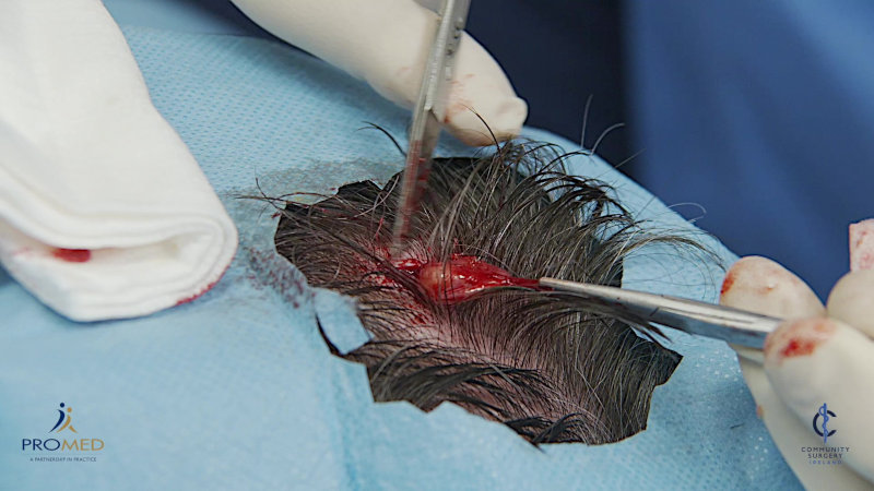 Removal of a pilar scalp cyst
