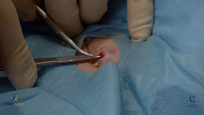 Removal of a sebaceous cyst
