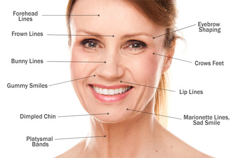 what are anti wrinkle injections good for