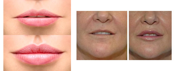 Fillers in the lip