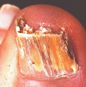 Fungal Nail Infection