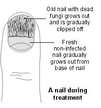 Fungal Nail Infection 2
